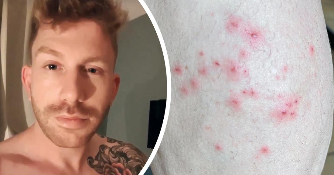 29949600-lars-toensfeuerborn-was-infected-with-monkey-pox-photo-collage-10xfko126zbg Lars Tönsfeuerborn war mit Affenpocken infiziert. (Fotocollage/Symbolbild)