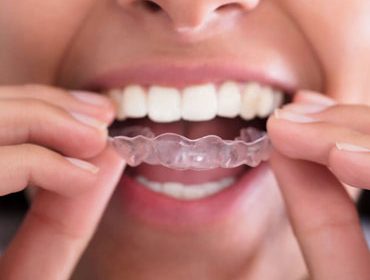 aligners for teeth straightening