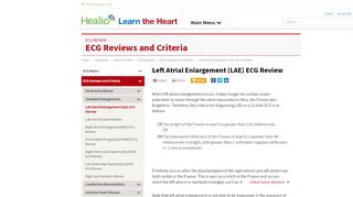 
                            8. Left Atrial Enlargement (LAE) ECG Review - Criteria and ... - Lae Cosm Portal
