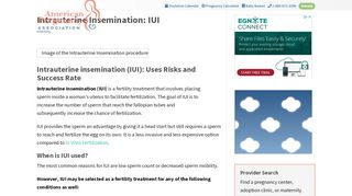 
                            2. Intrauterine insemination (IUI): Uses, Risks and Success Rate