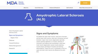 
                            7. ALS: Amyotrophic Lateral Sclerosis - Signs and Symptoms | Muscular ...