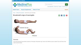 
                            2. Brudzinski's sign of meningitis: MedlinePlus Medical Encyclopedia ...