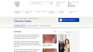 
                            5. Chronic hives - Symptoms and causes - Mayo Clinic
