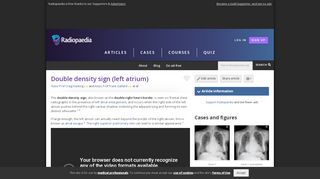 
                            4. Double density sign (left atrium) | Radiology Reference Article ...