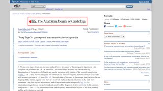 
                            2. “Frog Sign” in paroxysmal supraventricular tachycardia - NCBI - NIH