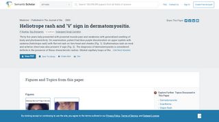 
                            11. Heliotrope rash and 'V' sign in dermatomyositis. - Semantic Scholar