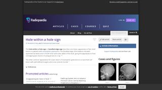 
                            11. Hole within a hole sign | Radiology Reference Article | Radiopaedia.org