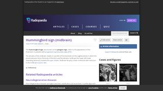 
                            1. Hummingbird sign (midbrain) | Radiology Reference Article ...