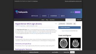 
                            4. Hyperdense MCA sign (brain) | Radiology Reference Article ...