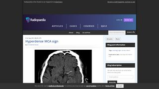 
                            5. Hyperdense MCA sign | Radiology blog post | Radiopaedia.org