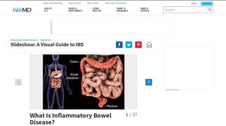 
                            12. IBD Pictures: Crohn's, Ulcerative Colitis Symptoms, Causes, and ...