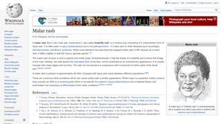 
                            11. Malar rash - Wikipedia