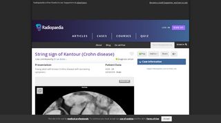 
                            3. String sign of Kantour (Crohn disease) | Radiology Case ...