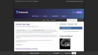 
                            1. Sunset eye sign | Radiology Reference Article | Radiopaedia.org