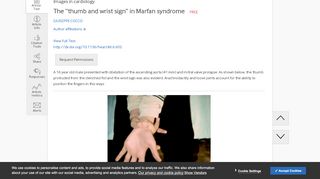 
                            9. The “thumb and wrist sign” in Marfan syndrome | Heart