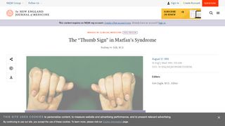 
                            3. The “Thumb Sign” in Marfan's Syndrome | NEJM