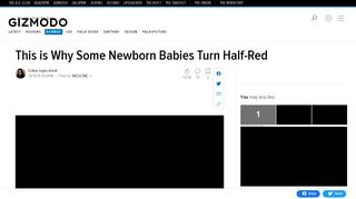 
                            4. This is Why Some Newborn Babies Turn Half-Red - Gizmodo