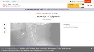 
                            4. “Thumb Sign” of Epiglottitis | NEJM