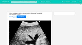 
                            9. Ultrasonography of the liver showing ''Playboy Bunny'' sign in a ...