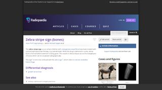 
                            6. Zebra stripe sign (bones) | Radiology Reference Article | Radiopaedia ...