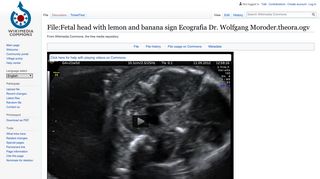 File:Fetal head with lemon and banana sign Ecografia Dr. Wolfgang ...