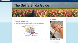 The Spina Bifida Guide: What is the 