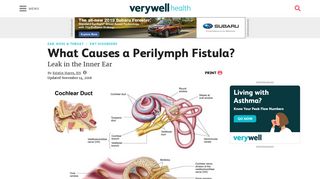 Symptoms and Causes of Perilymph Fistula - Verywell Health