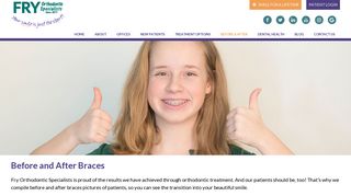 Before and After Braces | Invisalign Braces | Fry Orthodontics