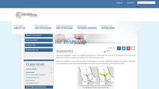 Asymmetry - Child Hip Dysplasia | International Hip Dysplasia Institute