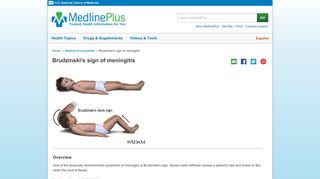 Brudzinski's sign of meningitis: MedlinePlus Medical Encyclopedia ...