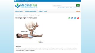 Kernig's sign of meningitis: MedlinePlus Medical Encyclopedia Image