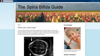 The Spina Bifida Guide: What is the 