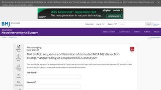 MRI SPACE sequence confirmation of occluded MCA M2 dissection ...