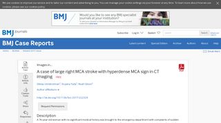 A case of large right MCA stroke with hyperdense MCA sign in CT ...
