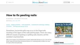 Peeling nails: Causes, treatment, and prevention - Medical News Today