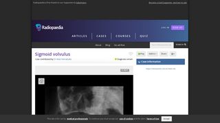 Sigmoid volvulus | Radiology Case | Radiopaedia.org