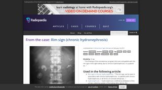 Rim sign (chronic hydronephrosis) | Image | Radiopaedia.org