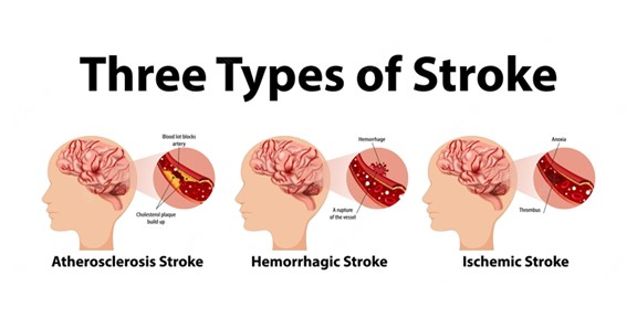 The Different Types of Stroke Explained In Simple Ways -