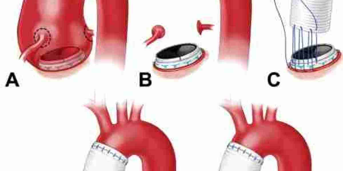 Bentall Procedure in India – Advanced Life-Saving Aortic Root Surgery