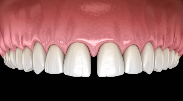 Can Dental Bonding Fix Gaps Between Teeth? – Telegraph