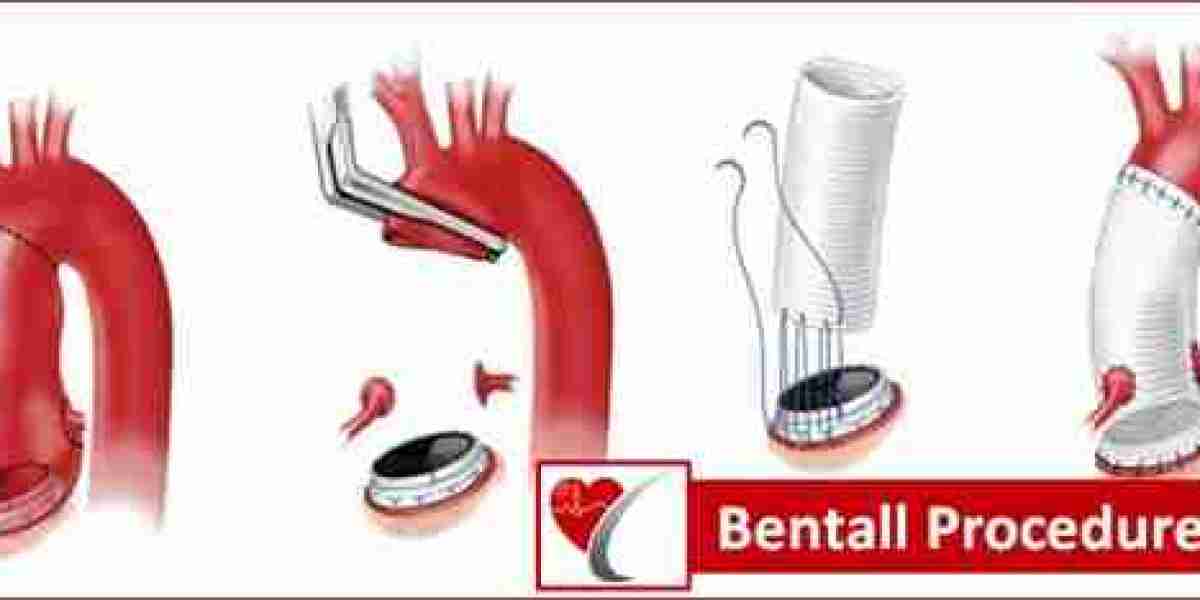 Bentall Procedure in India – Advanced Life-Saving Aortic Root Surgery