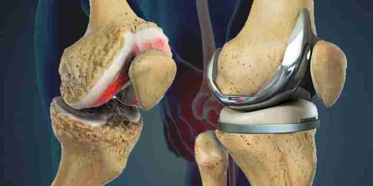 Best Knee Replacement Surgeons in India – Comprehensive Guide for Patients