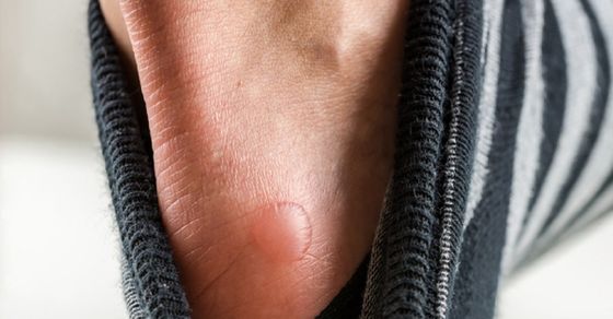 Coronavirus symptoms: Foot sores may be the most recent exposed indication of COVID-19