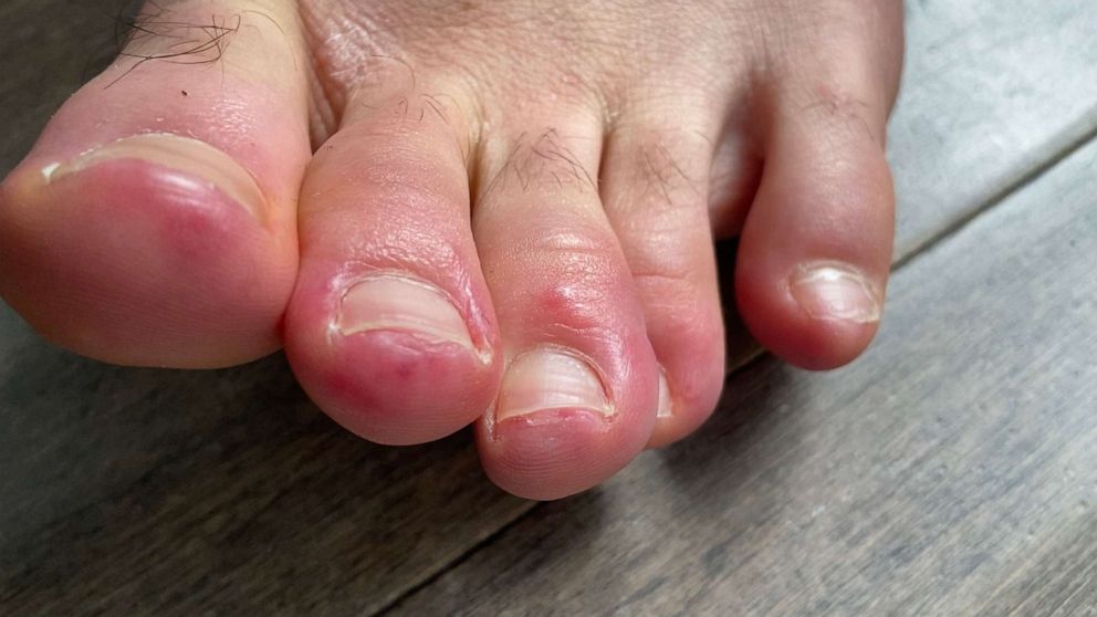 ‘COVID Toes’: Could skin problem provide coronavirus ideas?