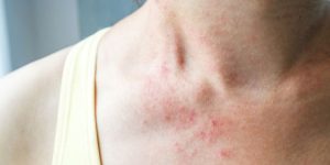 A Skin Rash May Be a New, Rare Sign of Coronavirus, According to Doctors