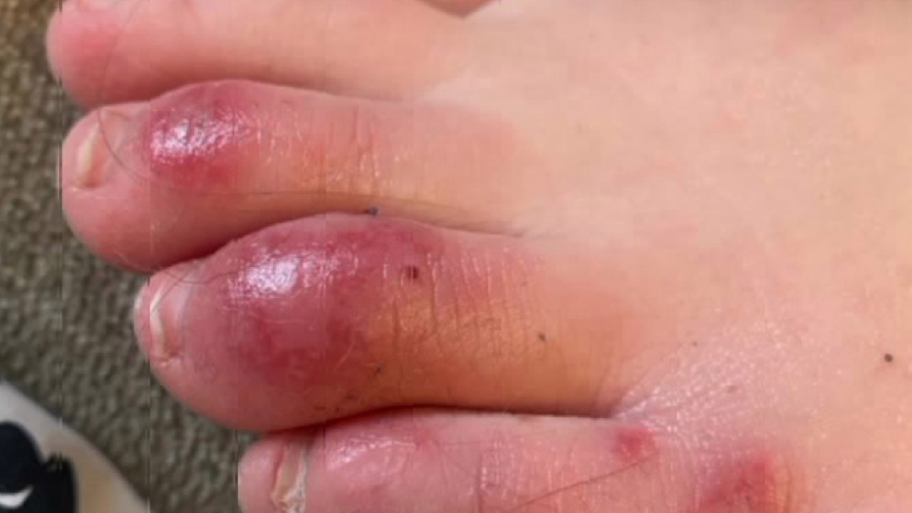 covid-toes-puzzling-condition-a-possible-coronavirus-symptom-in-young-people.jpg ‘COVID toes’: Puzzling condition a possible coronavirus symptom in young people
