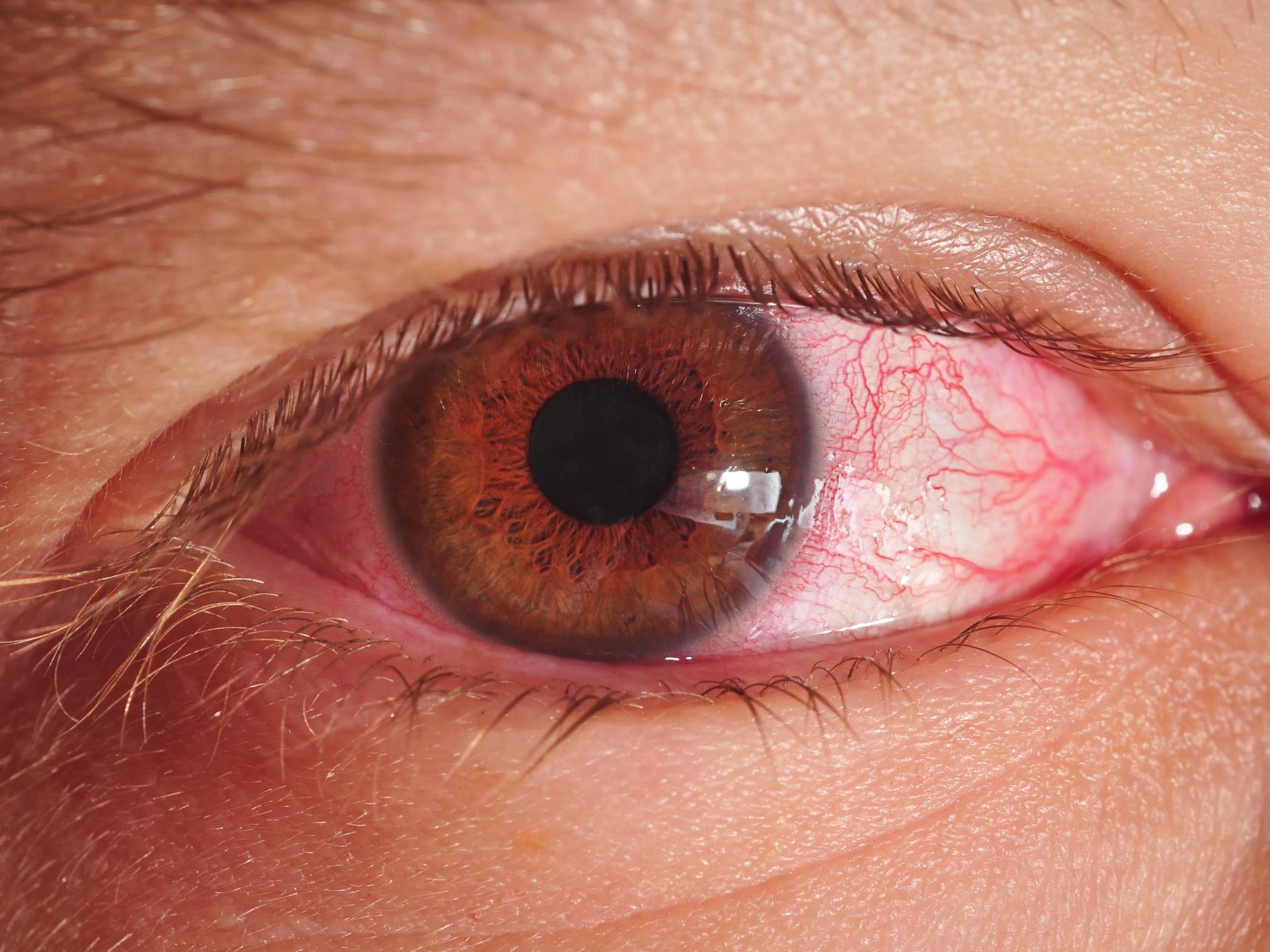 Coronavirus: Eyes could be contagious for weeks, research study discovers