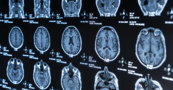 new-drug-target-for-schizophrenia.jpg New drug target for schizophrenia
