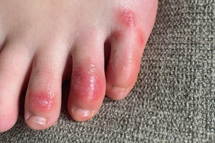 ‘COVID toes,’ other rashes latest possible rare virus signs