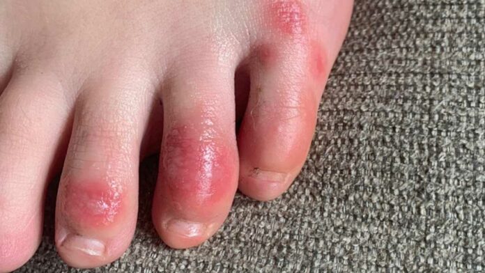 ‘COVID toes,’ other rashes latest possible rare coronavirus signs